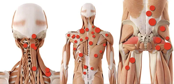 Trigger point Mappa dei trigger point